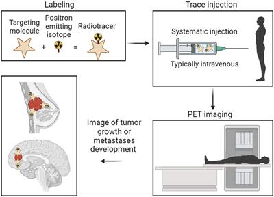 The application of radionuclide therapy for breast cancer